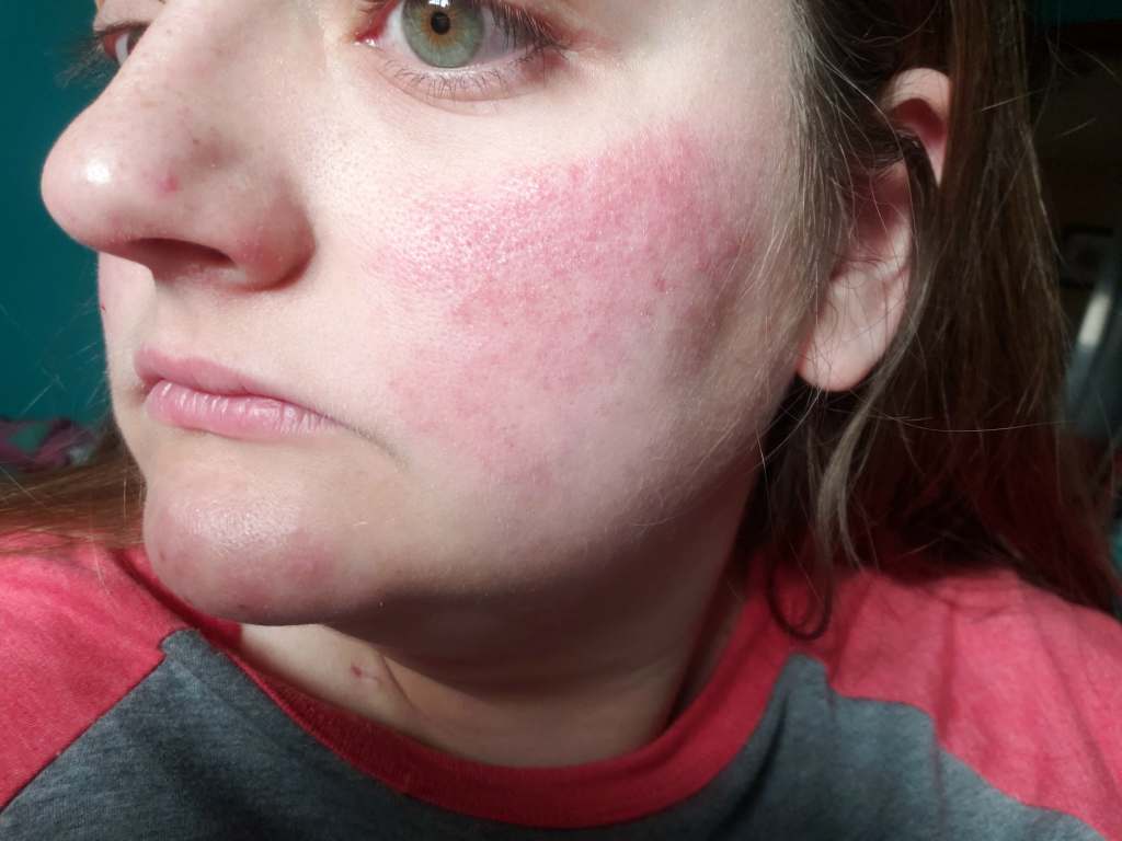 skin rash from chemo